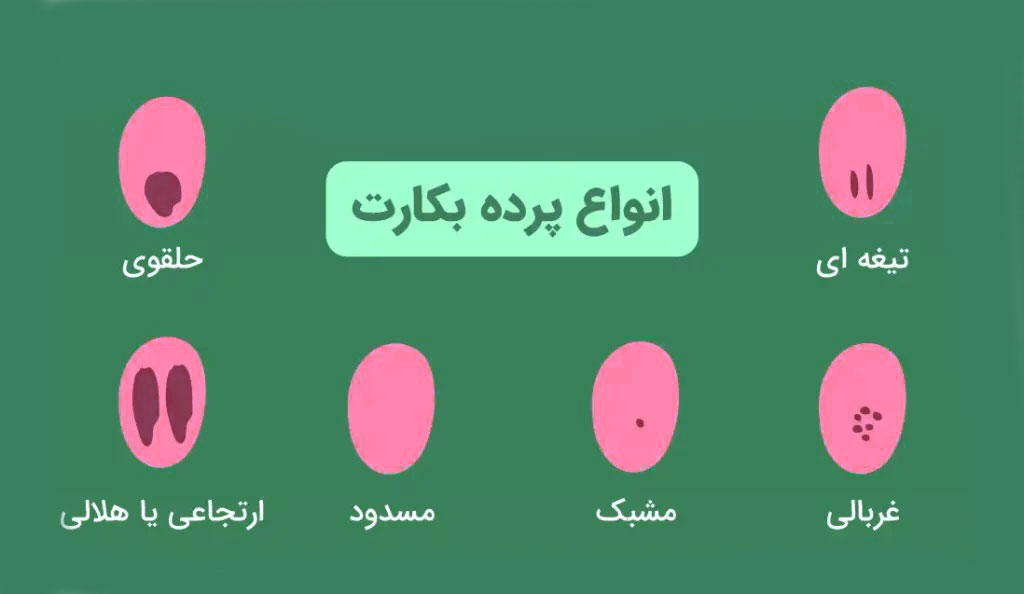 چگونه بفهمیم پرده بکارت سالم است با عکس