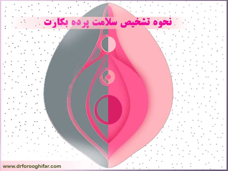 چگونه بفهمیم پرده بکارت سالم است با عکس