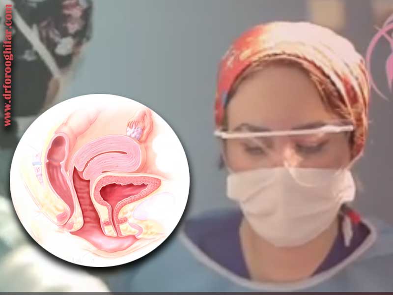 درمان افتادگی واژن در تهران0 (0)
