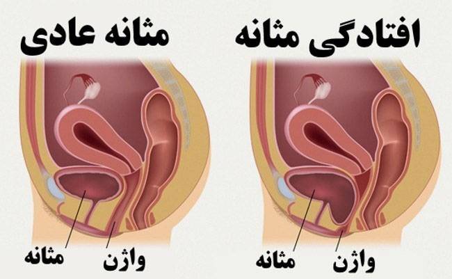 درمان-افتادگی-واژن-در-تهران