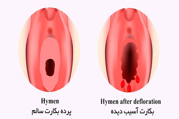 هزینه دوخت پرده بکارت