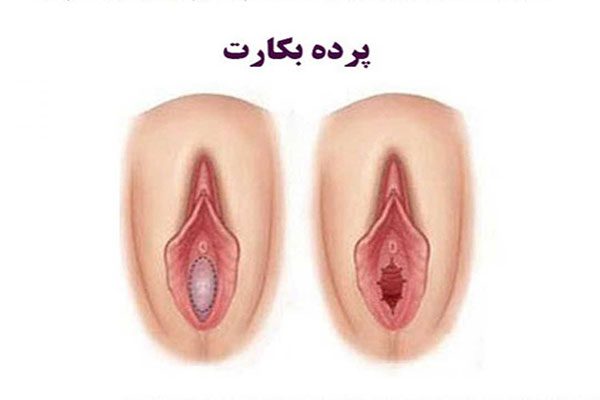 هزینه دوخت پرده بکارت