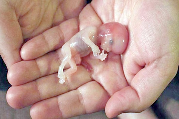 نشانه های سقط جنین
